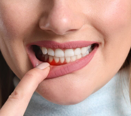 Tratamento Periodontal